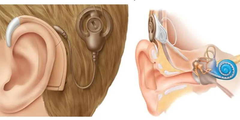 Cấy Ốc Tai Điện Tử Chữa Điếc
