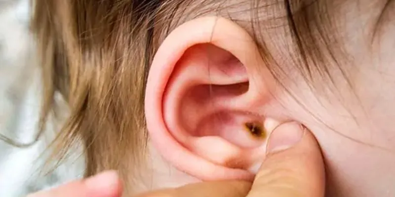 triệu chứng viêm tai ngoài ở trẻ