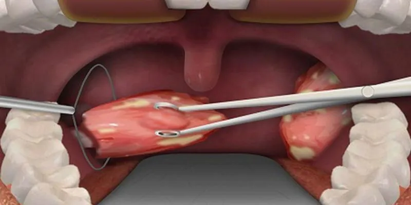 sau khi phẫu thuật cắt Amidan