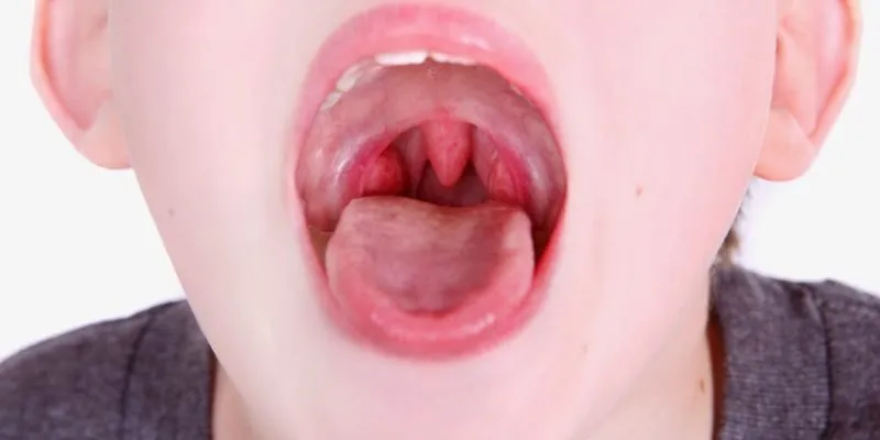 trẻ bị viêm VA