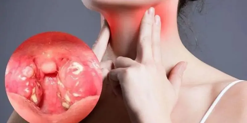 Các triệu chứng viêm họng mãn tính